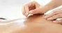 Dry Needling Physiotherapist Port Elizabeth